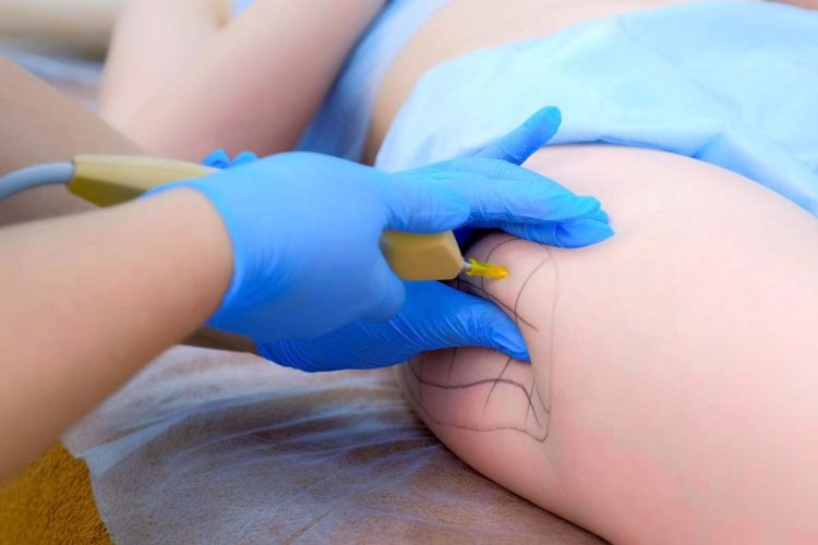 Carbossiterapia trattamento contro la cellulite